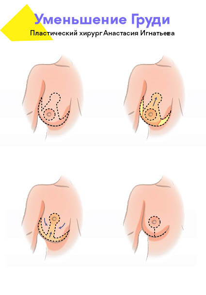 как уменьшают грудь